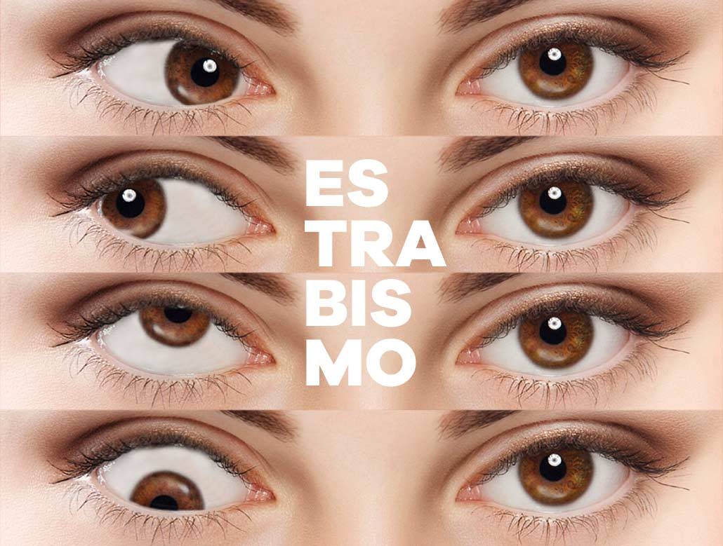 estrabismo